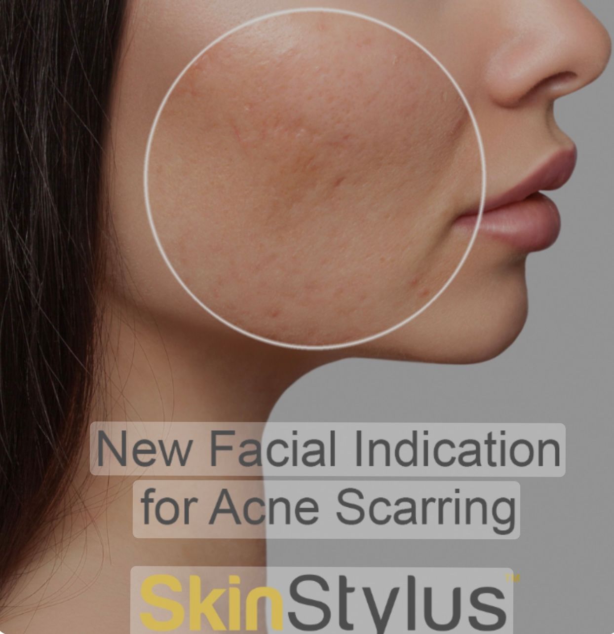 Smooths acne scars with microneedling in North RIchland Hills, Texas