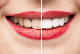 Teeth Whitening—Cosmetic Dentistry in Moorpark, CA