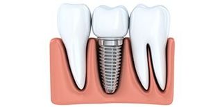 Implant Restoration—Cosmetic Dentistry in Moorpark, CA