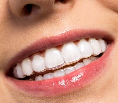 Invisible Braces—Cosmetic Dentistry in Moorpark, CA