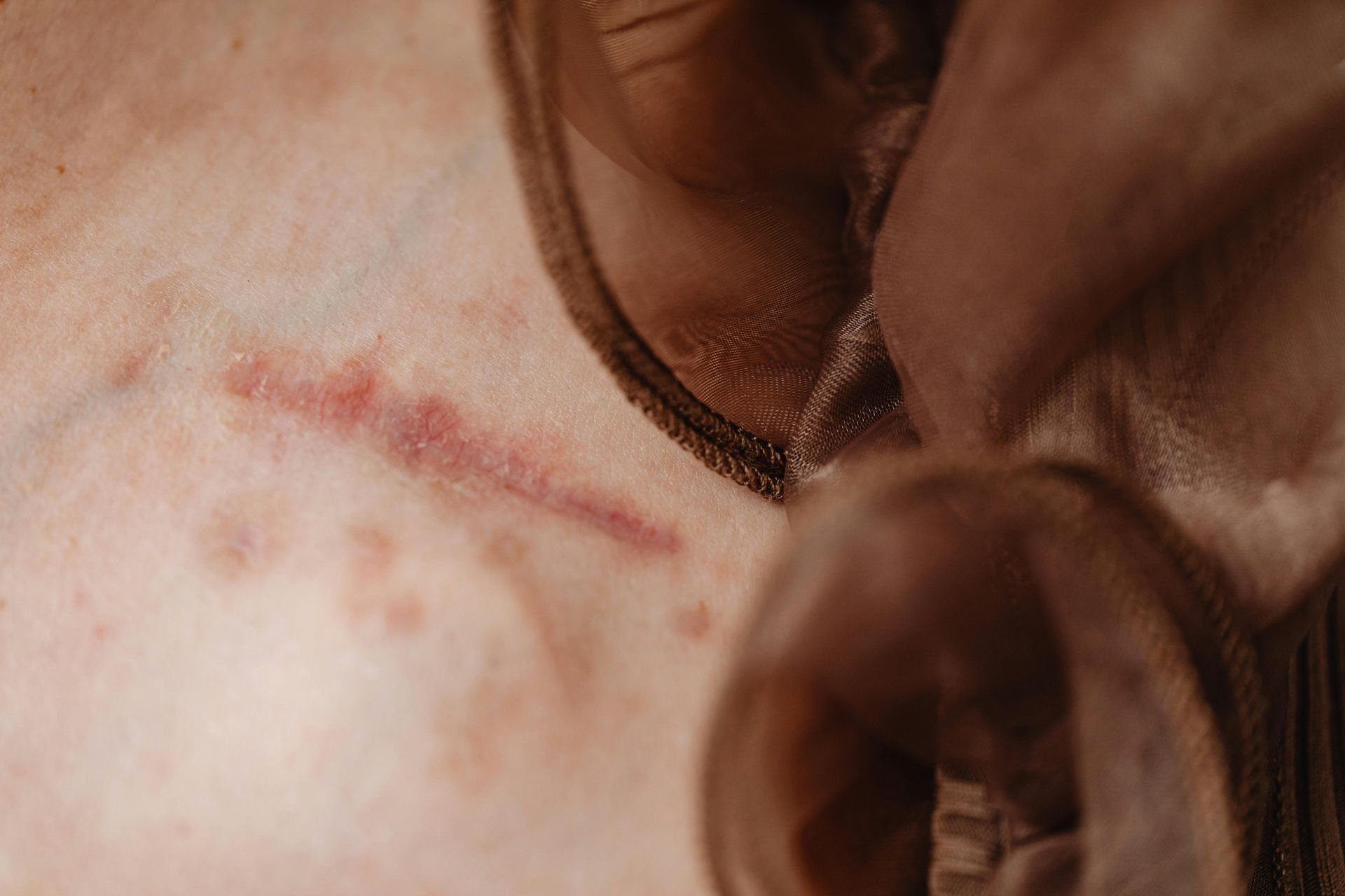 Close-up of a healing scar as evidence of personal injuries.