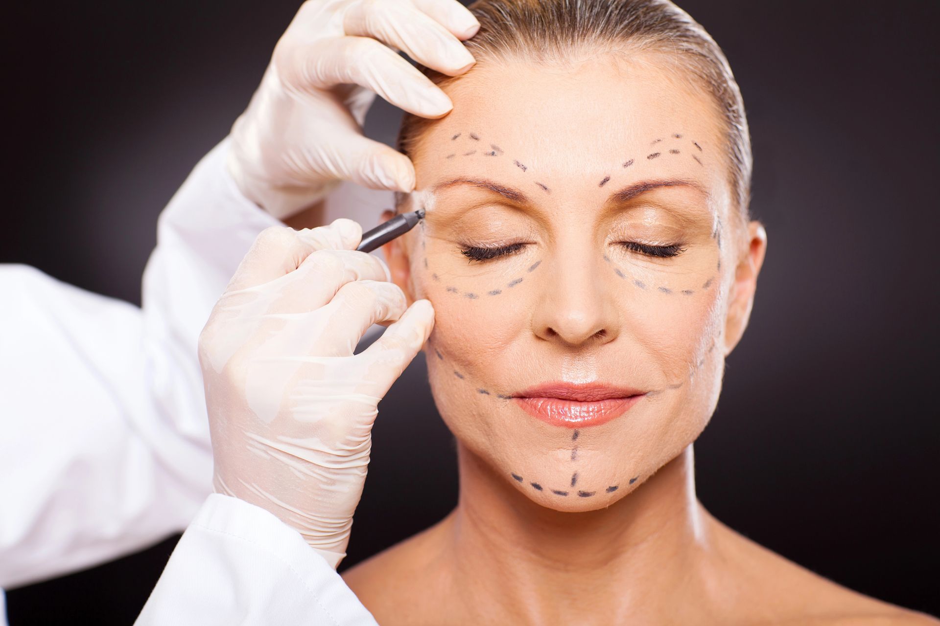 Rostro de mujer marcado con líneas para cirugía estética, manos enguantadas del médico sosteniendo un bolígrafo.