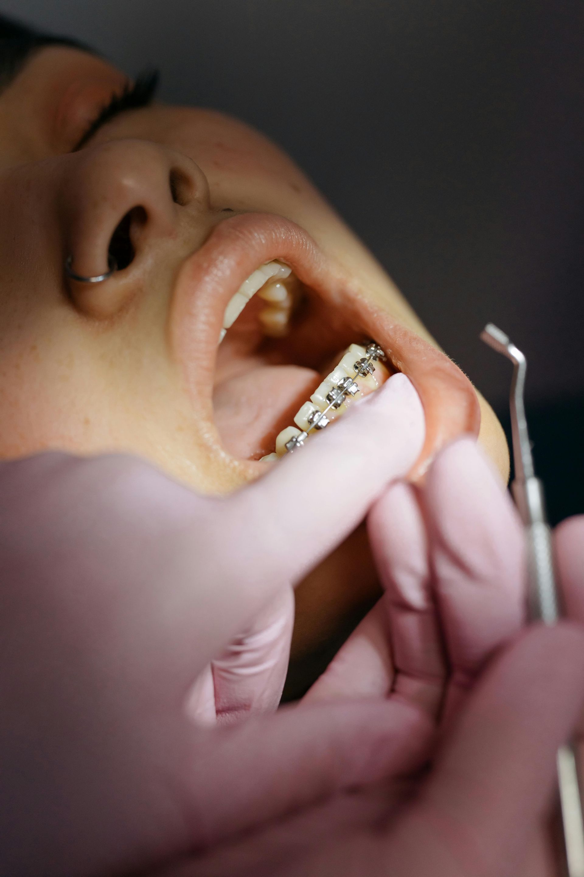 Dentista examinando los dientes de un paciente con brackets. Mano con guante rosa y herramientas visibles.