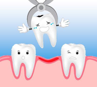 Estrazione dentale