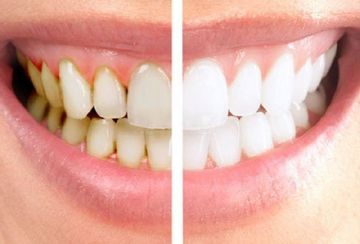 Denti inferiori superiori Faccette sbiancamento perfetto sorriso adulto  Comfort naturale Fit Denti Protesi cosmetiche Denti falsi