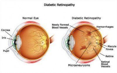 Diabetic Retinopathy — Melbourne — East St. Kilda Eye Clinic