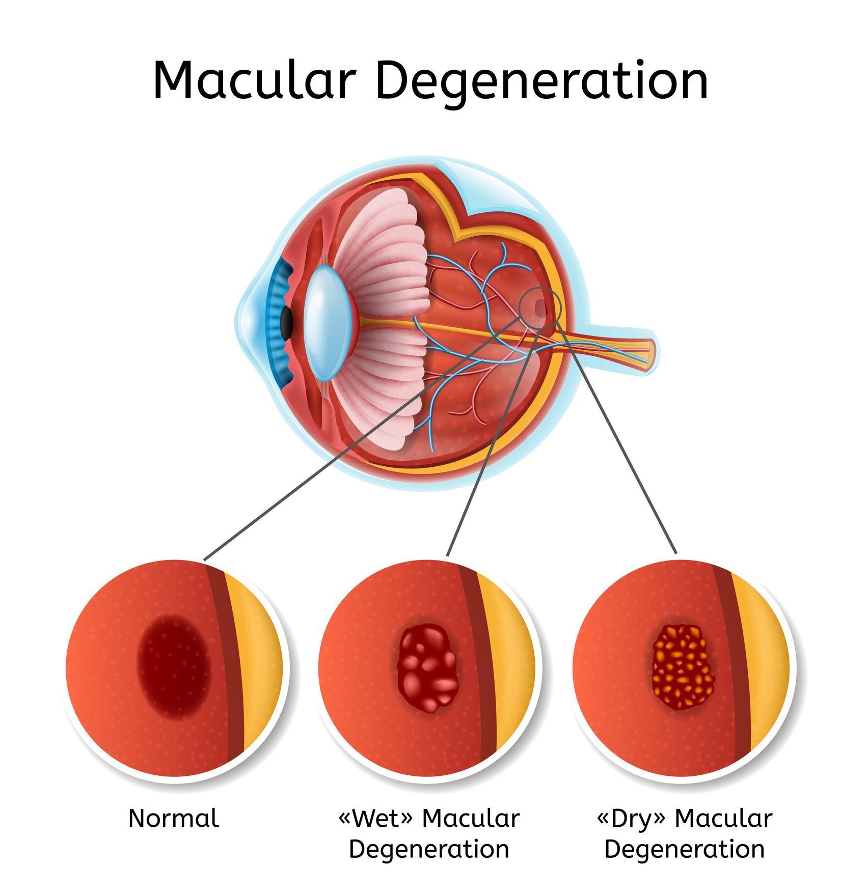 An illustration of a medical diagram with an eye anatomy, highlighting macular degeneration.