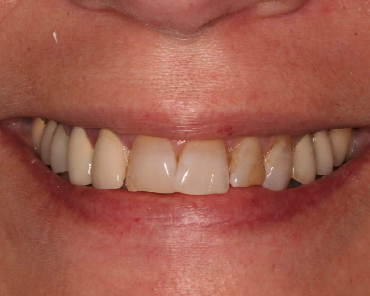 Woman with blue eyes and a wide smile, teeth slightly yellowed.