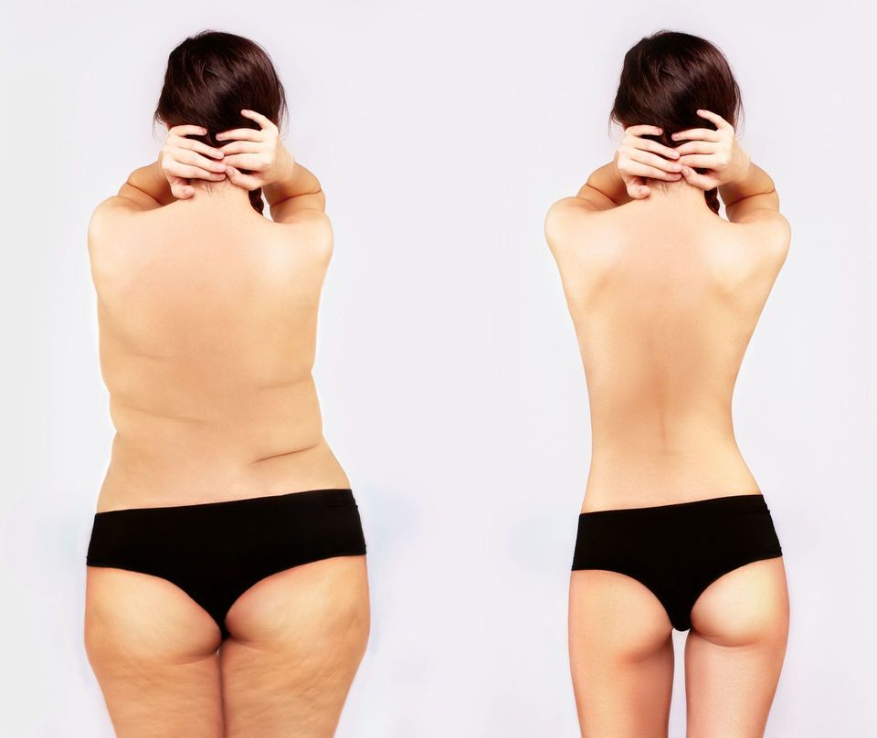 corpo femminile prima e dopo trattamento snellente
