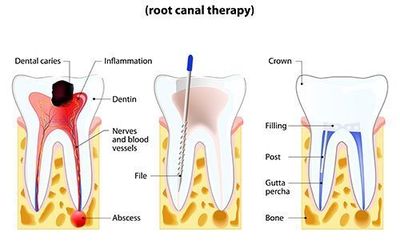 root canal Gloversville, NY