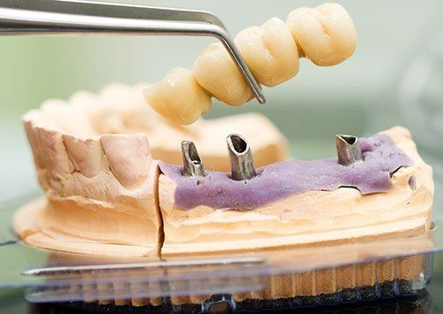 root canal Gloversville, NY