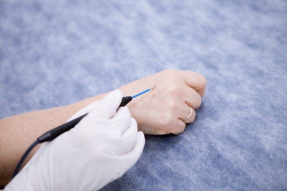 Un dermatologo che esegue la rimozione di alcune macchie cutanee dalla mano di una paziente