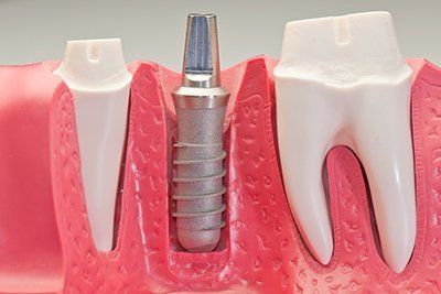 Dental Implant — Statesville, NC — Joseph M. Perry, D.D.S., P.A.