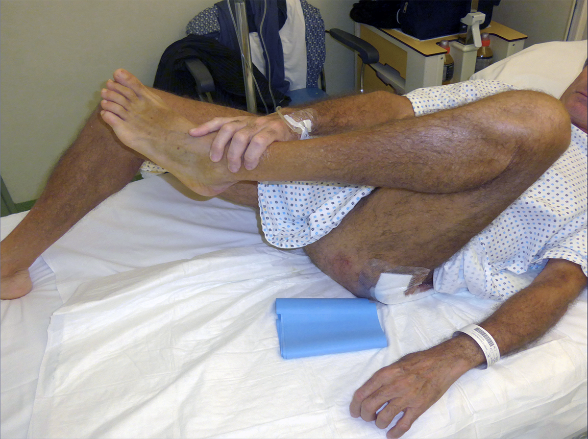 mobilizzazione precoce protesi ginocchio anca