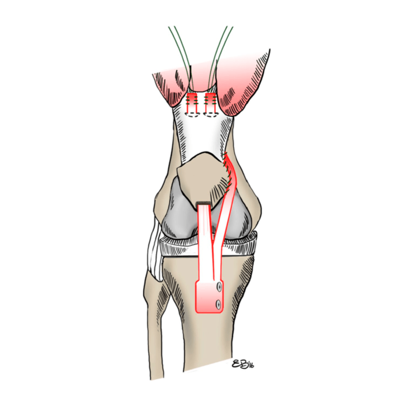 Ricostruzione tendine rotuleo protesi ginocchio