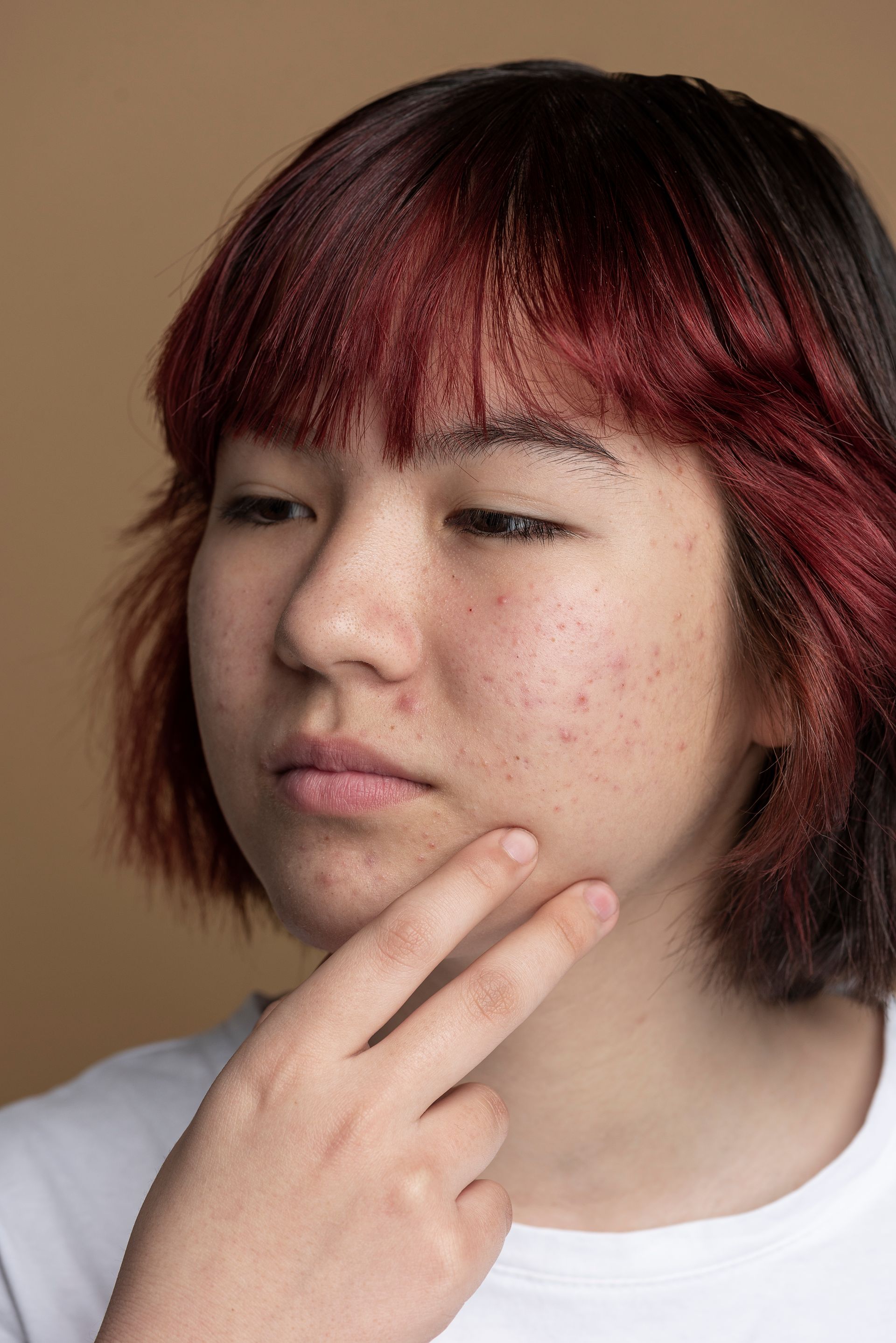 A woman with acne on her face is looking towards the side.