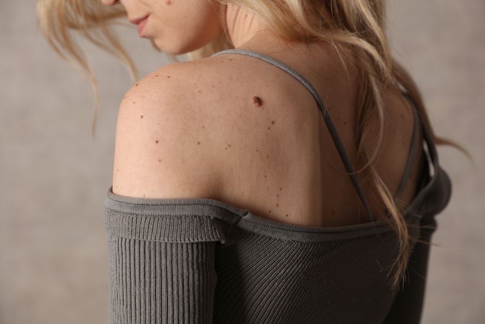 Woman's shoulder with moles, wearing a gray off-the-shoulder sweater, fair skin.