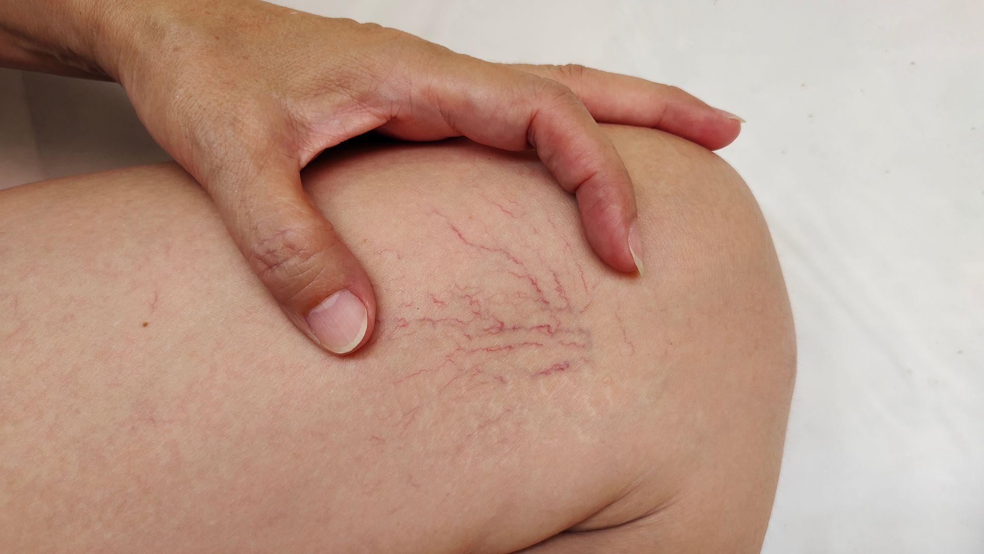 A person is touching a woman 's leg with varicose veins.