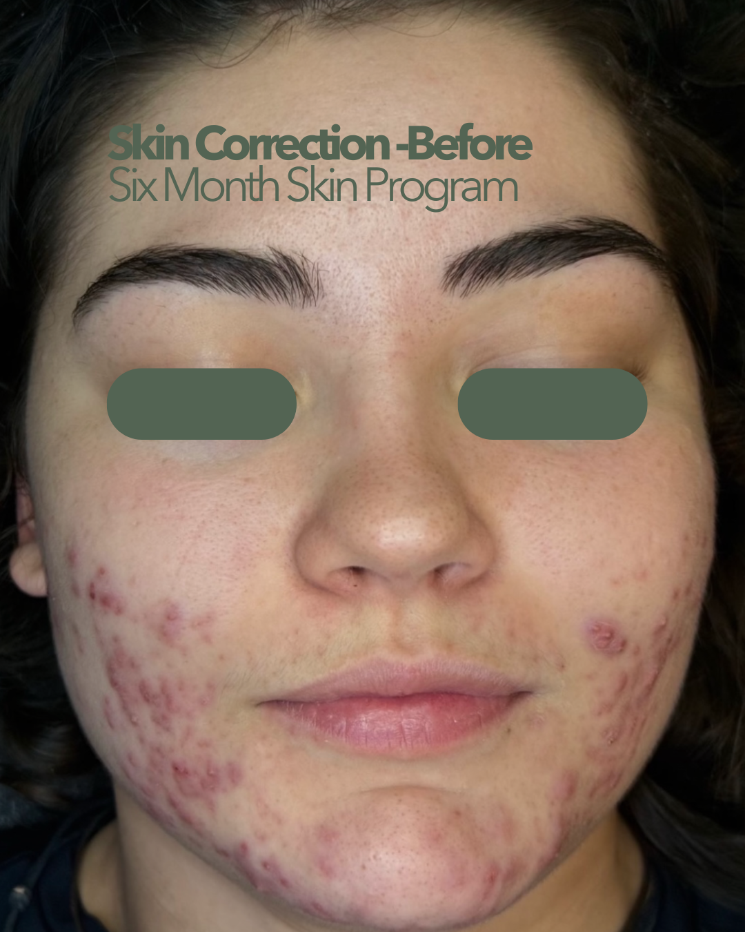 Face With Acne Before Six-month Skin Program — That Skin Clinic in Mooloolaba, QLD
