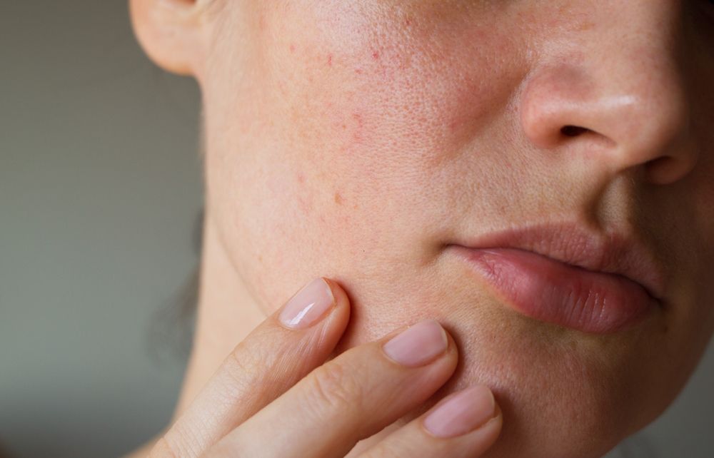 Close-up of a Person's Face With Red, Irritated Skin — That Skin Clinic in Mooloolaba, QLD