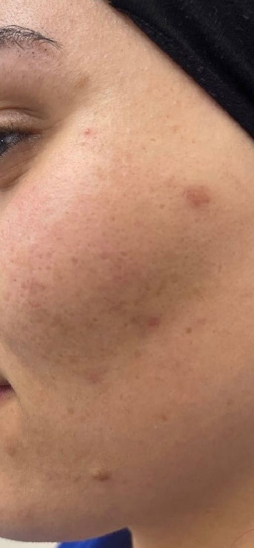 Before and after photos showing improvement in skin texture and clarity.