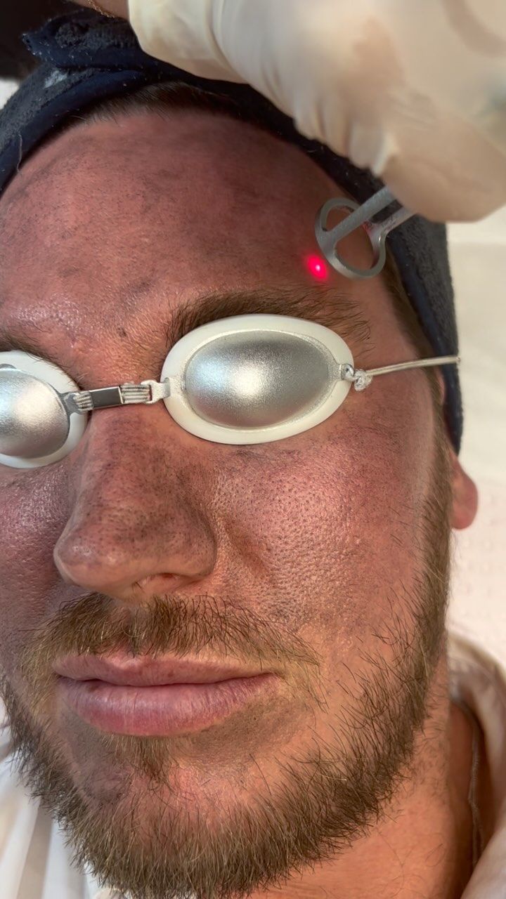 Person Receiving Laser Treatment on Their Forehead, Wearing Protective Eye Goggles — That Skin Clinic in Mooloolaba, QLD
