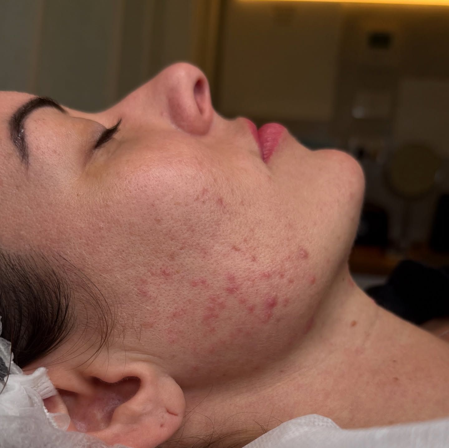 Woman with closed eyes, skin with reddish acne marks. Profile view, indoor setting.