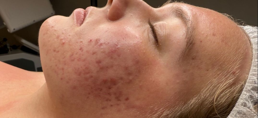 Close-up of a Person's Face, With Reddish Skin Discoloration and Pimples Around the Jawline — That Skin Clinic in Mooloolaba, QLD