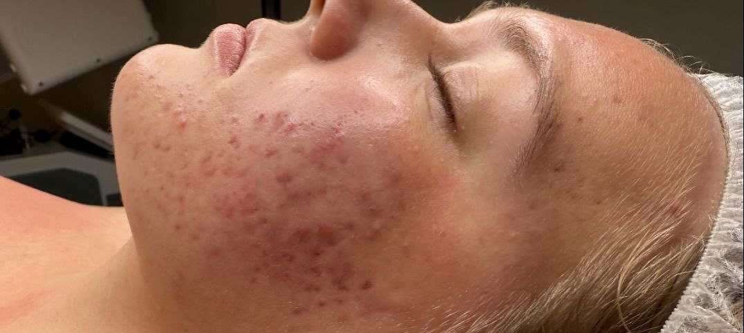Side-by-side comparison of a person's skin before and after treatment for acne, showing improvement in redness and blemishes.
