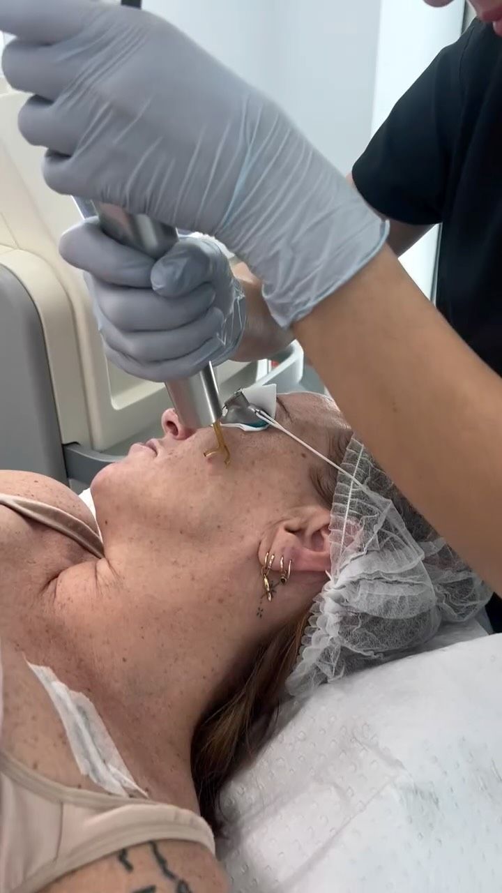 Person Receiving Facial Laser Treatment — That Skin Clinic in Mooloolaba, QLD
