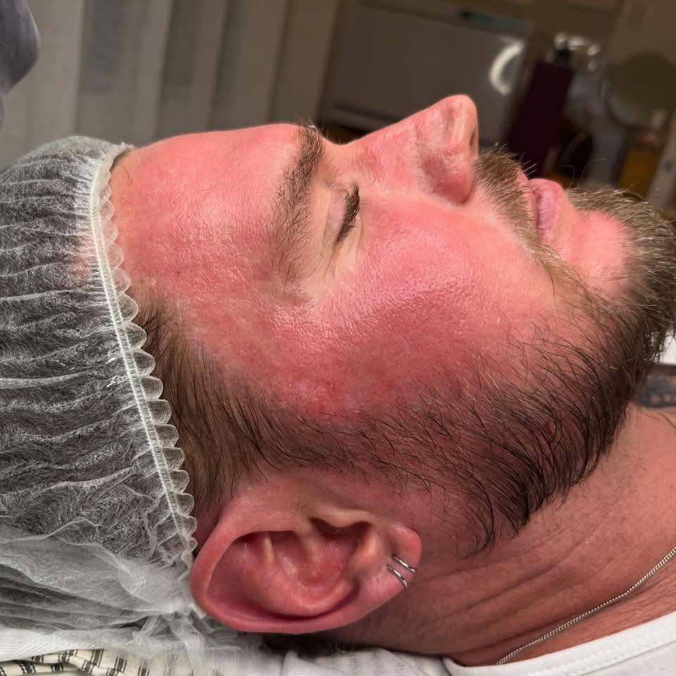 Man With Red Skin, Possibly Post-facial Treatment, Wearing a Hair Net — That Skin Clinic in Mooloolaba, QLD
