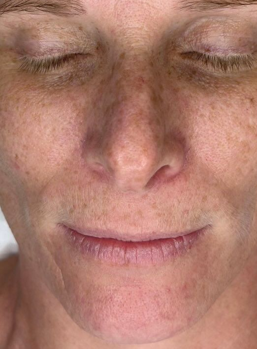 Close-up of a Person's Face With Closed Eyes and a Slight Smile — That Skin Clinic in Mooloolaba, QLD