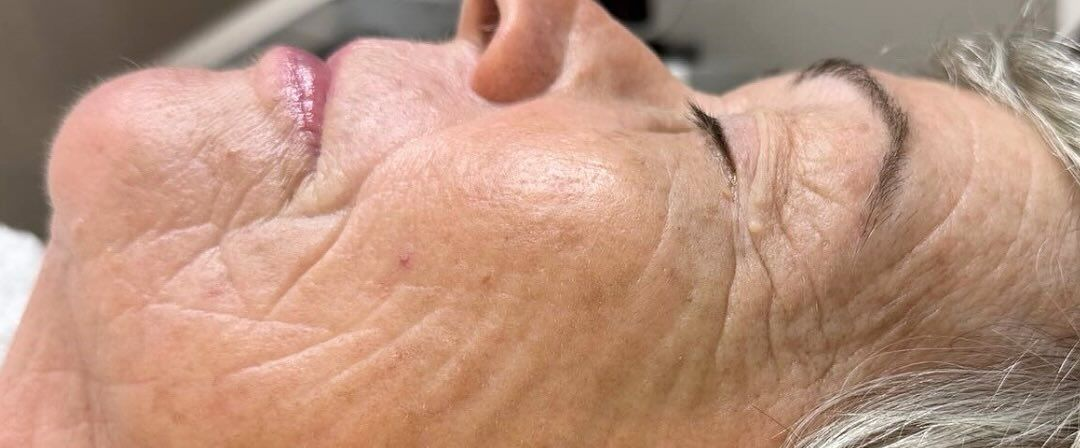 Close-up of a Person's Face Showing Wrinkles and Skin Texture — That Skin Clinic in Mooloolaba, QLD