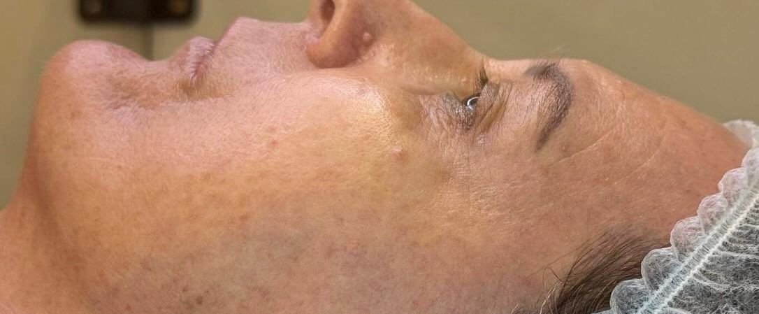 Profile of a Person's Face, Skin Texture Visible — That Skin Clinic in Mooloolaba, QLD