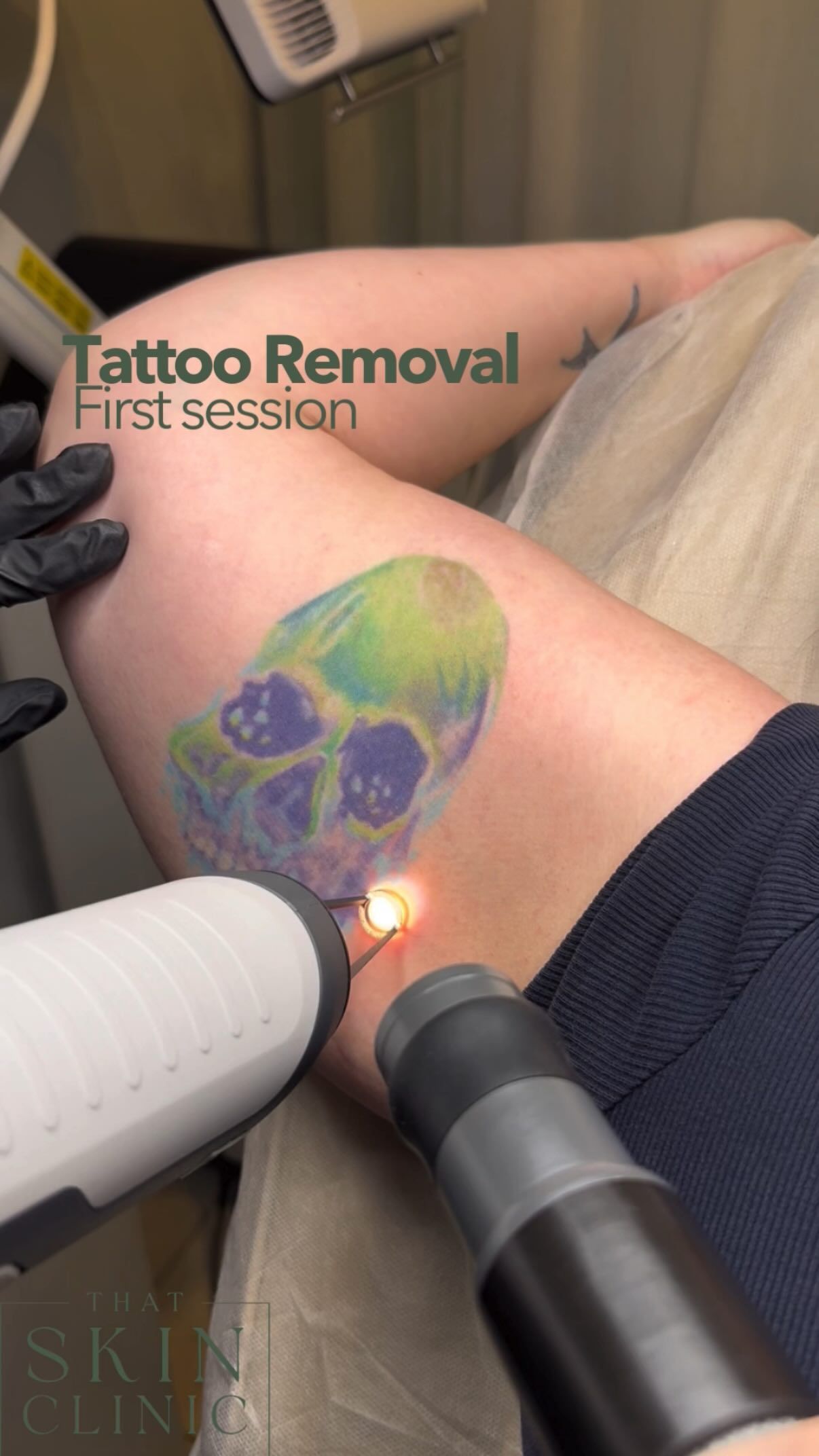 Laser Tattoo Removal on a Colorful Skull Tattoo, First Session — That Skin Clinic in Mooloolaba, QLD