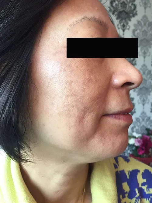 Woman's Face With Brown Skin, Showing Areas of Discoloration on the Cheek and Jawline — That Skin Clinic in Mooloolaba, QLD