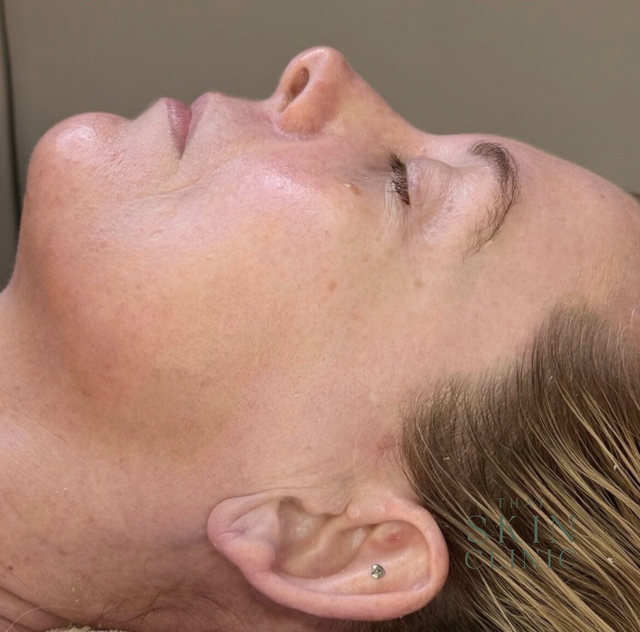 Side Profile of a Person Lying Down With Eyes Closed on a Clinic Treatment Bed — That Skin Clinic in Mooloolaba, QLD