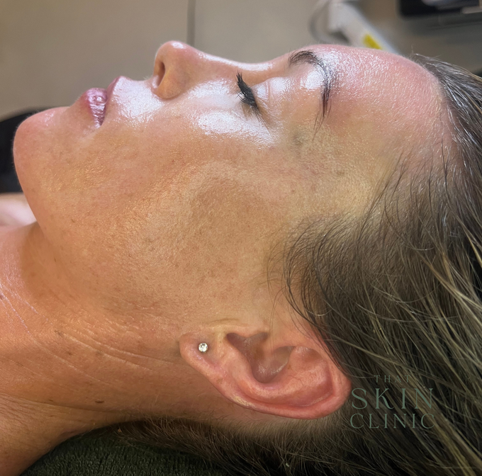 Close-up of a Woman Lying on Her Side With Eyes Closed — That Skin Clinic in Mooloolaba, QLD