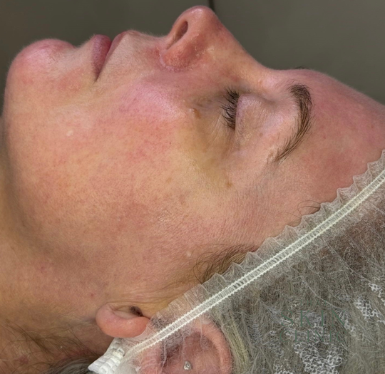 Close-up of a Woman Lying on Her Side With Eyes Closed, Wearing a Hairnet — That Skin Clinic in Mooloolaba, QLD