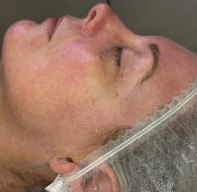 Close-up of a Woman Lying on Her Side With Eyes Closed, Wearing a Hairnet — That Skin Clinic in Mooloolaba, QLD