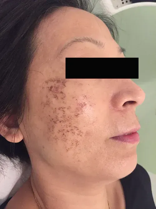 Woman's face with numerous small, dark spots on the cheek and forehead.