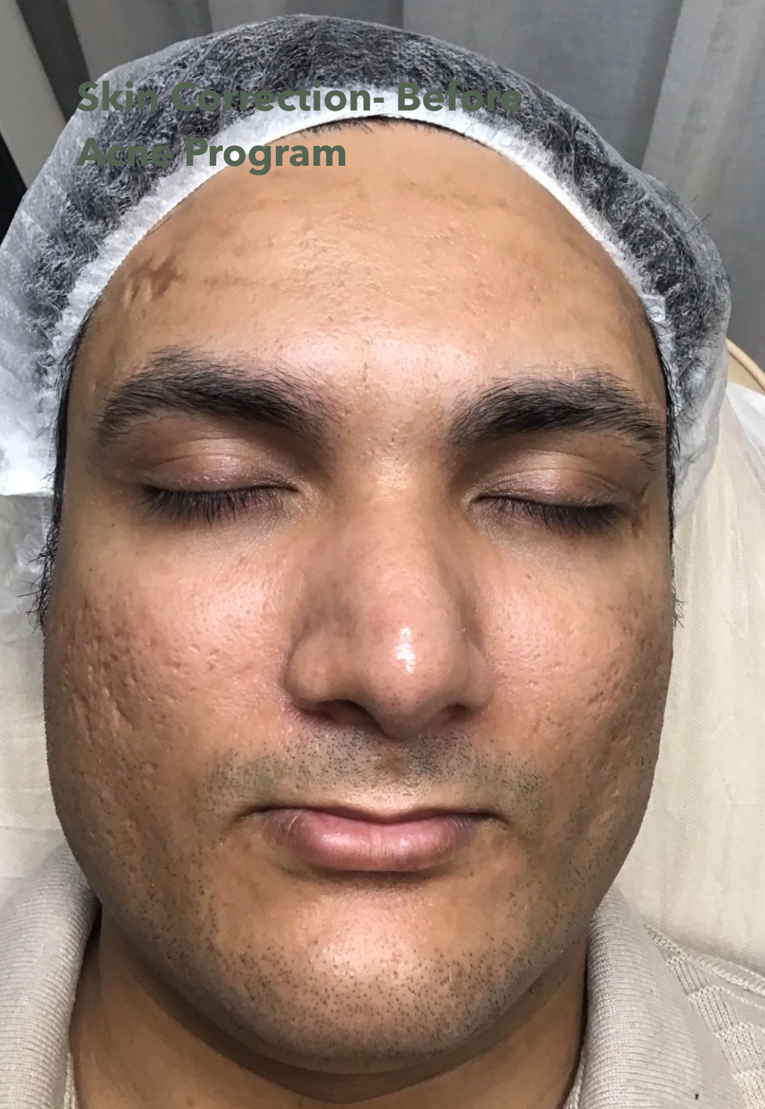Woman's Face Pre-skin Needling — That Skin Clinic in Mooloolaba, QLD