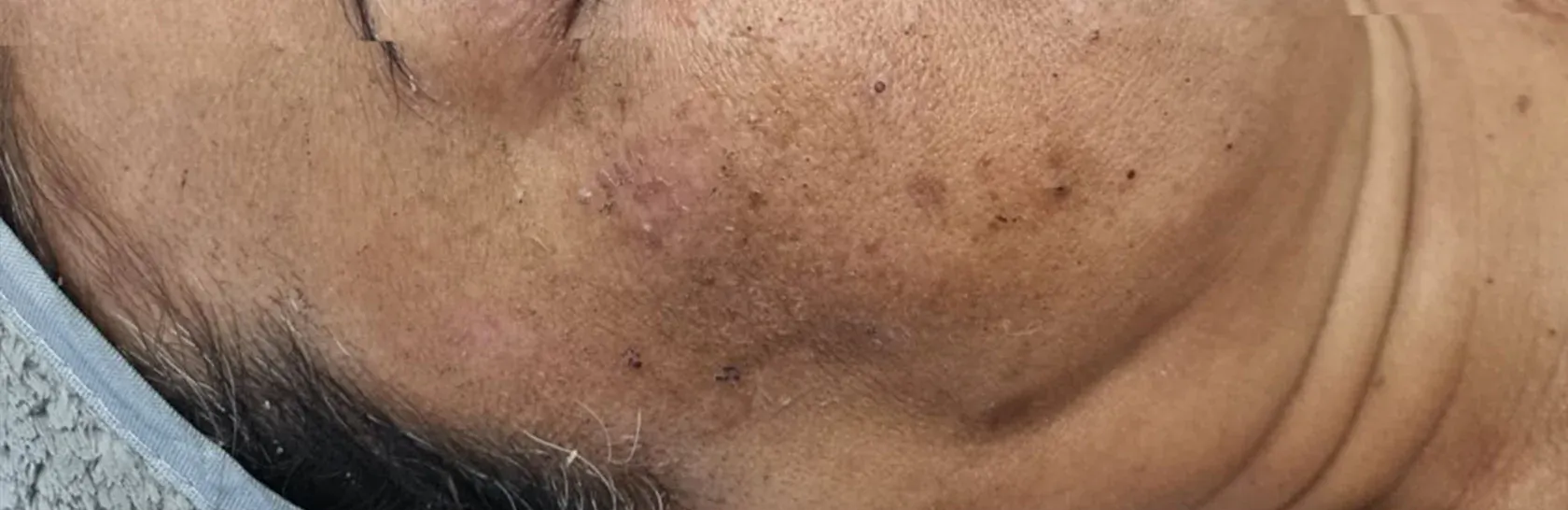 Person's Skin With Visible Pores and Discoloration — That Skin Clinic in Mooloolaba, QLD