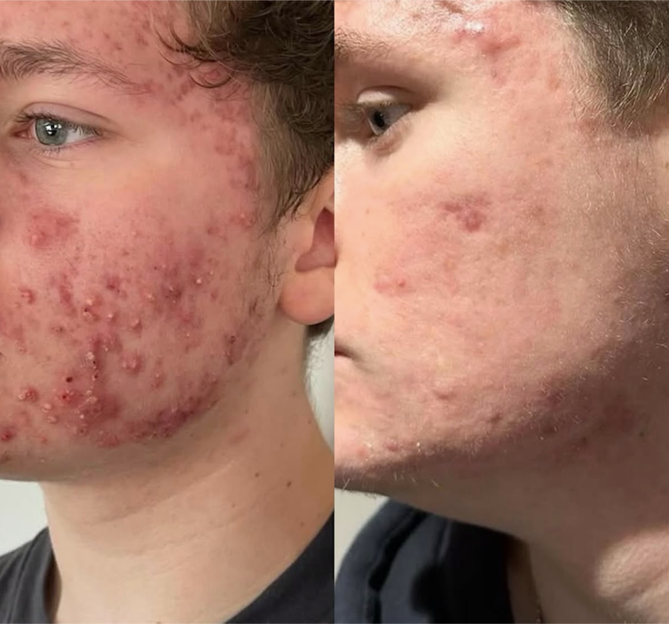 Side-by-side photos show a person with severe acne on the left, and clear skin on the right.