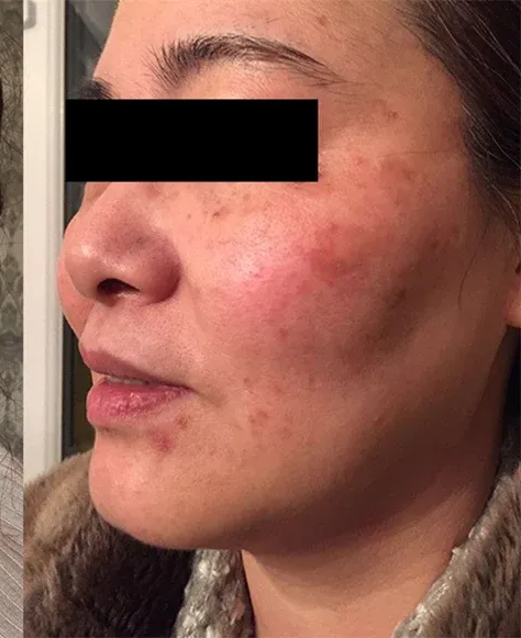 Side-by-side Photos of a Person's Face Showing Reduction in Dark Spots — That Skin Clinic in Mooloolaba, QLD