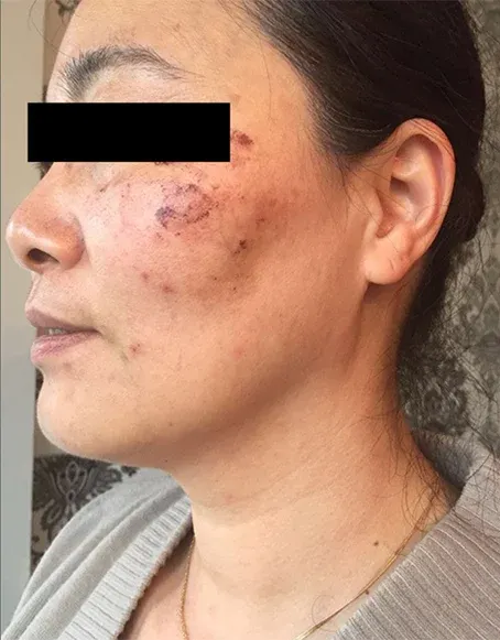Before-and-after of a person's face showing skin discoloration reduction. Left side has more dark spots. Right side has less.