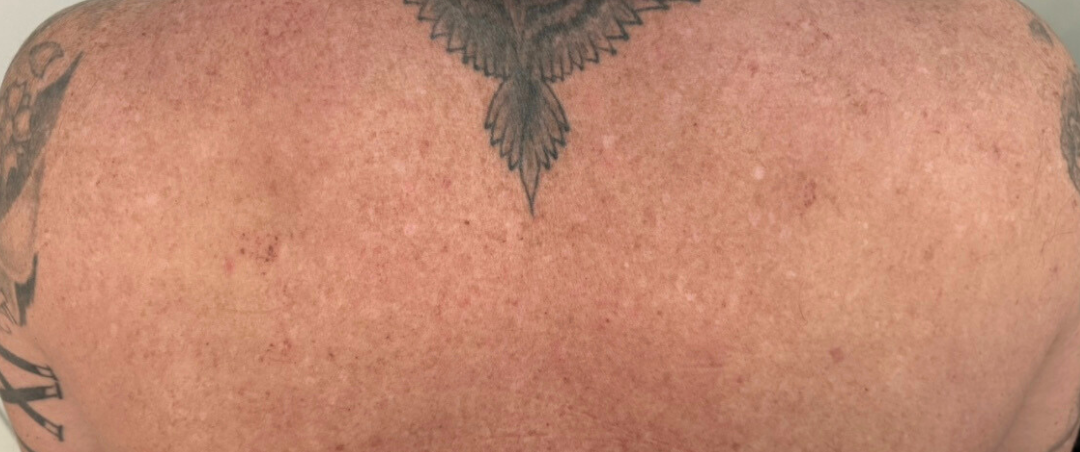 Back of a Person With a Tattoo on the Upper Back, Skin is Visible, Small Bumps Are Present — That Skin Clinic in Mooloolaba, QLD