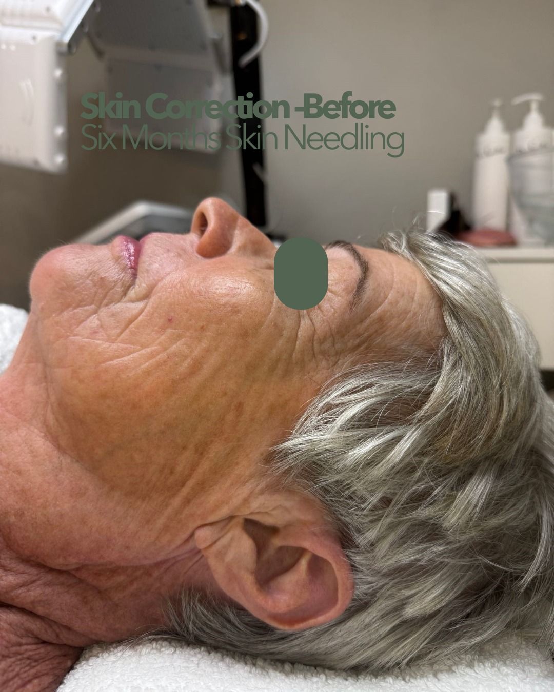 Profile View of a Person's Face — That Skin Clinic in Mooloolaba, QLD