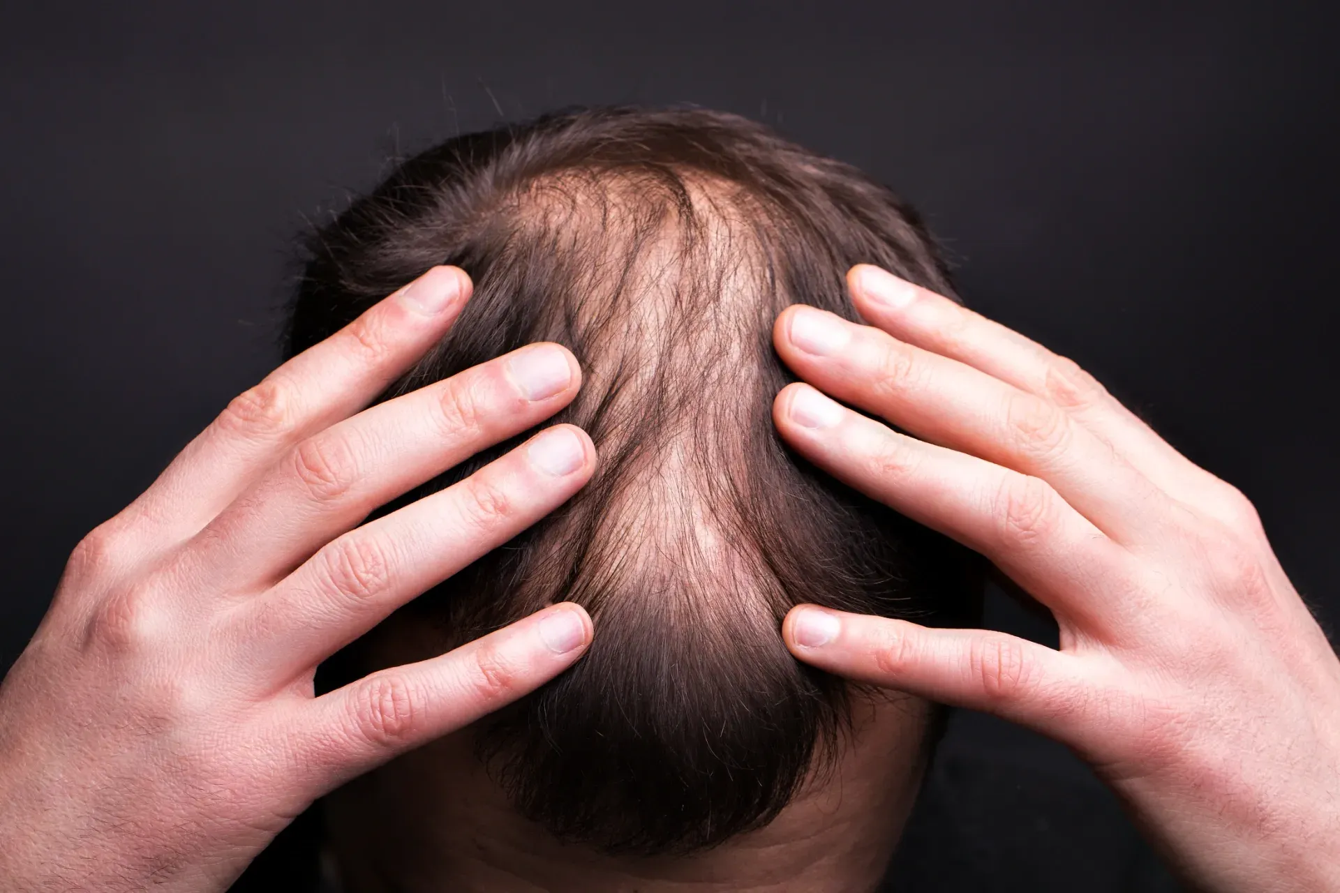 Before and after comparison of hair loss treatment showing increased hair growth.