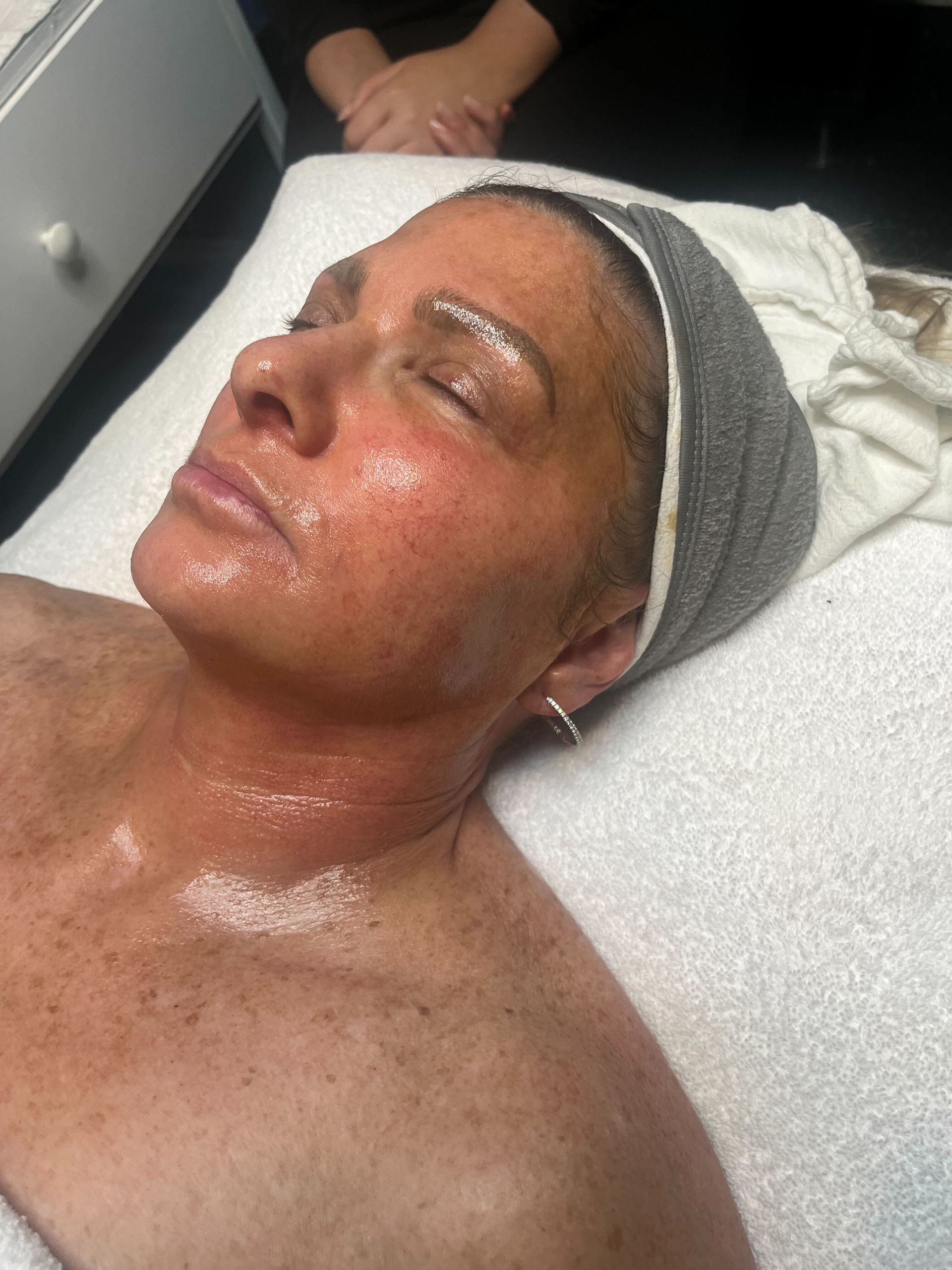 The guests skin at the end of the Progressive Chemical Peel service